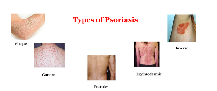 An Overview of Best Ayurvedic Hospitals for Psoriasis in Hyderabad