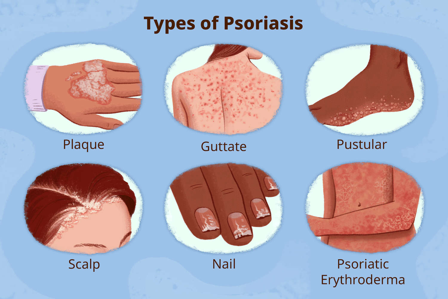 What is Psoriasis ?
