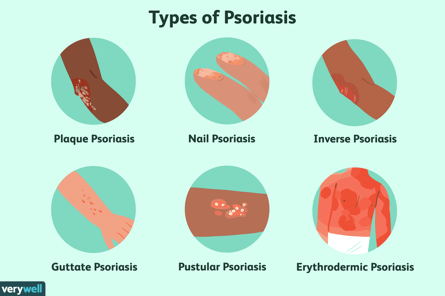 Where does psoriasis affect us?