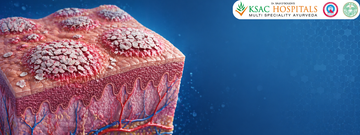 Psoriasis Ayurvedic Treatment in Hyderabad: Evidence-Based Purification Protocols for Lasting Skin Health
