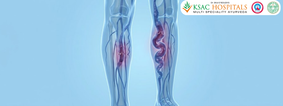 Varicose Veins Ayurvedic Treatment | KSAC Hyderabad